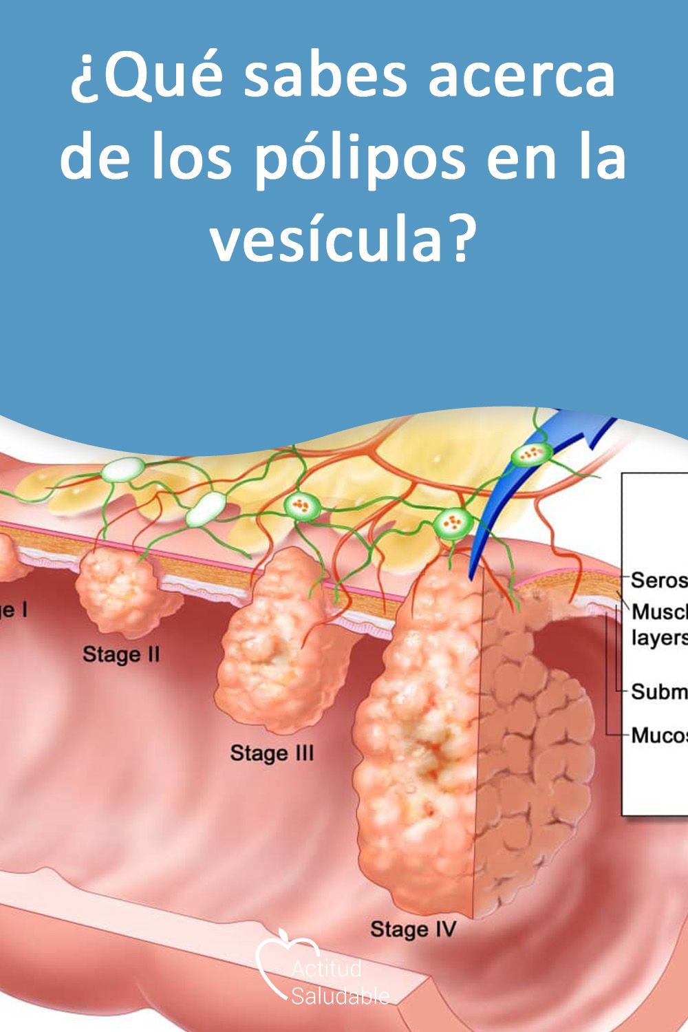 polipo vesicular tratamiento natural polipo vesicular tratamiento natural