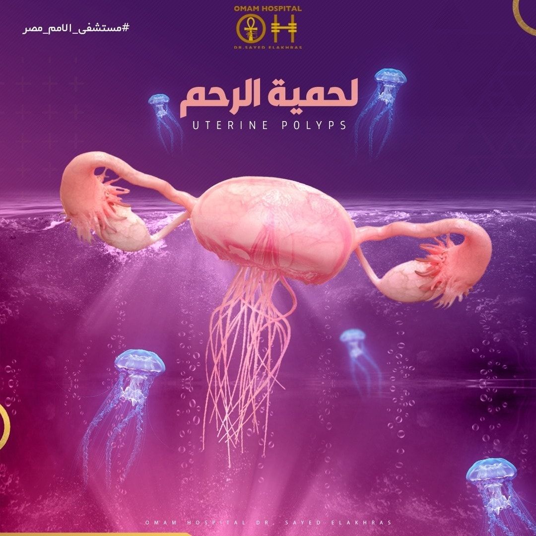 الاورام الحميدة الرحمية الاورام الحميدة الرحمية هي اورام تحدث في بطانة الرحم ، البطانة الداخلية للرحم ، المكان الذي تنمو فيه الزوائد اللحمية في الرحم.