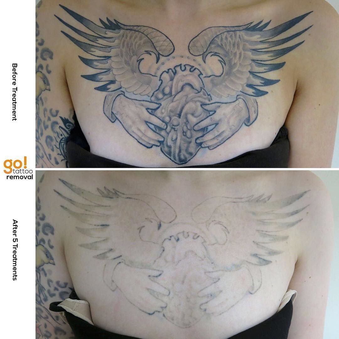Amazing Progress On This Chest Piece After 2 Laser Tattoo Removal Treatments A Few More And It Will Be Gone Forever