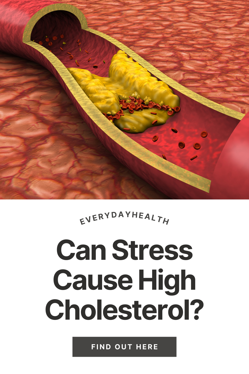 Can Stress Cause High Cholesterol Levels Pin on Heart Health