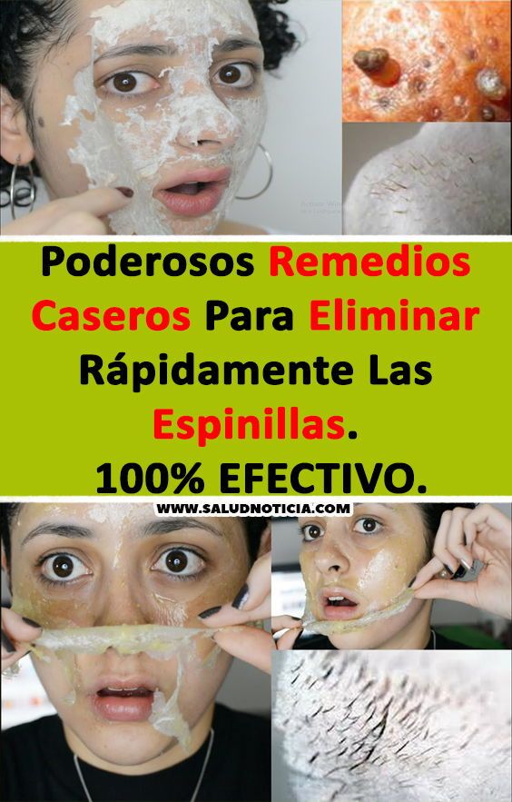 Consejos Y Remedios Caseros Para Eliminar Las Espinillas Y Puntos Negros De La Nari Consejos Naturales De Belleza Consejos Para La Piel Tips De Belleza Caseros Remedios Caseros Para Eliminar Espinillas En Un Dia