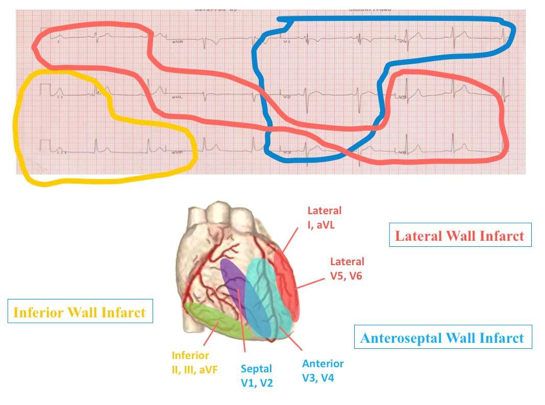 Grouping Leads On A 12 Lead EKG Where They Represent Medical School Grouping Leads On A 12 Lead EKG Where They Represent Medical School