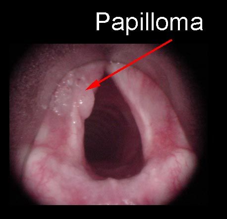 papilloma bocca immagini