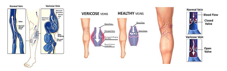 cauzele venelor varicoase interne