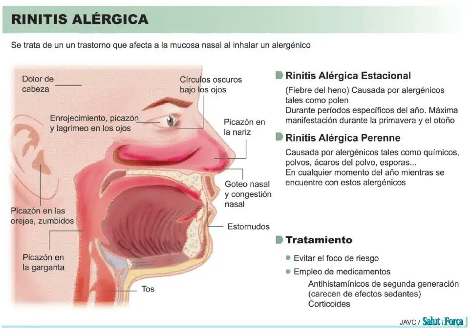 tratamiento rinitis alergica perenne tratamiento rinitis alergica perenne
