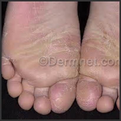 Types Of Eczema On Hands And Feet Eczema Free Forever Eczema On Hands Eczema Hands Types Of Eczema On Hands And Feet Eczema Free Forever Eczema On Hands Eczema Hands