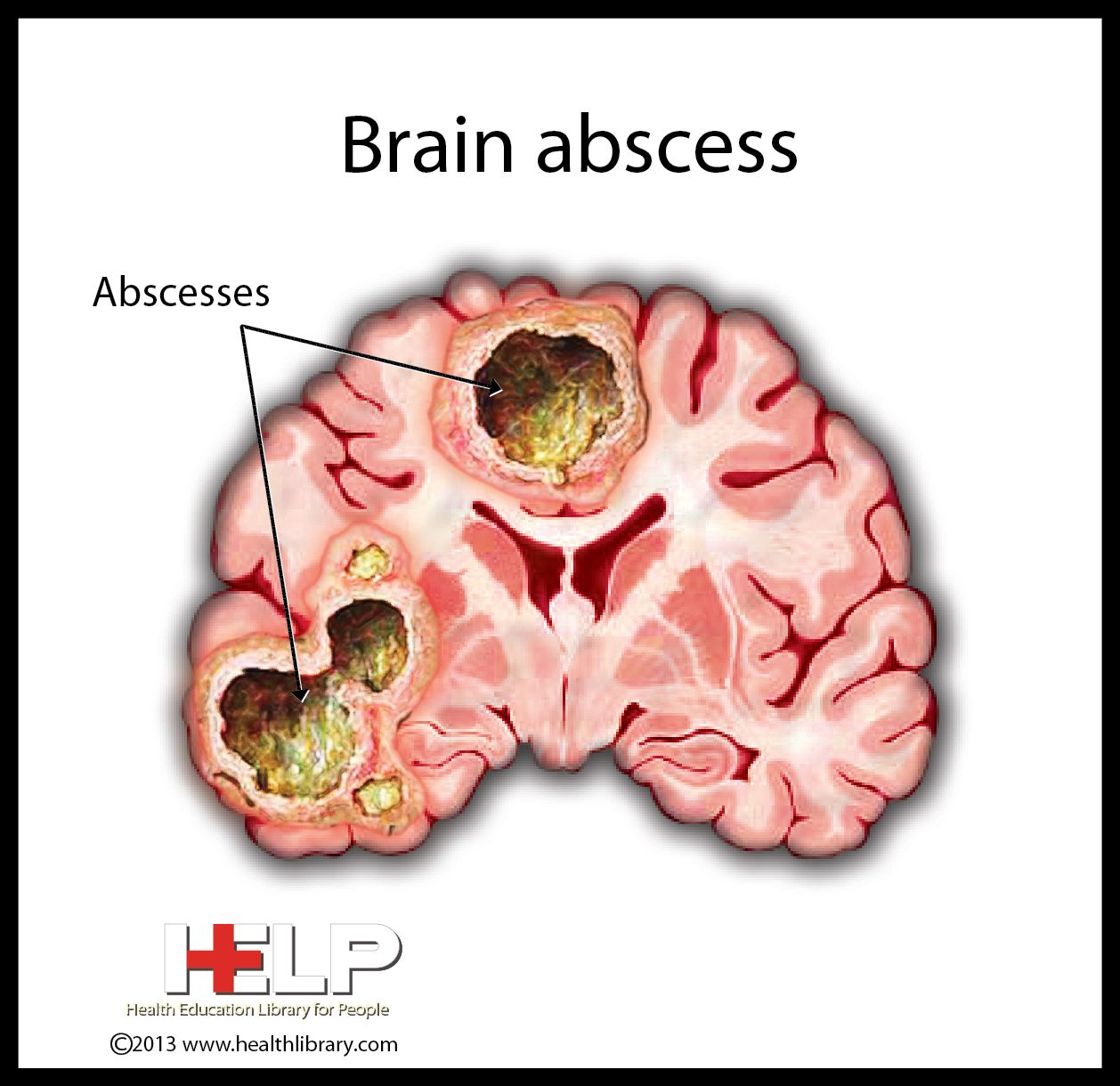 Brain Abscess Nclex, Nurse practioner, Health