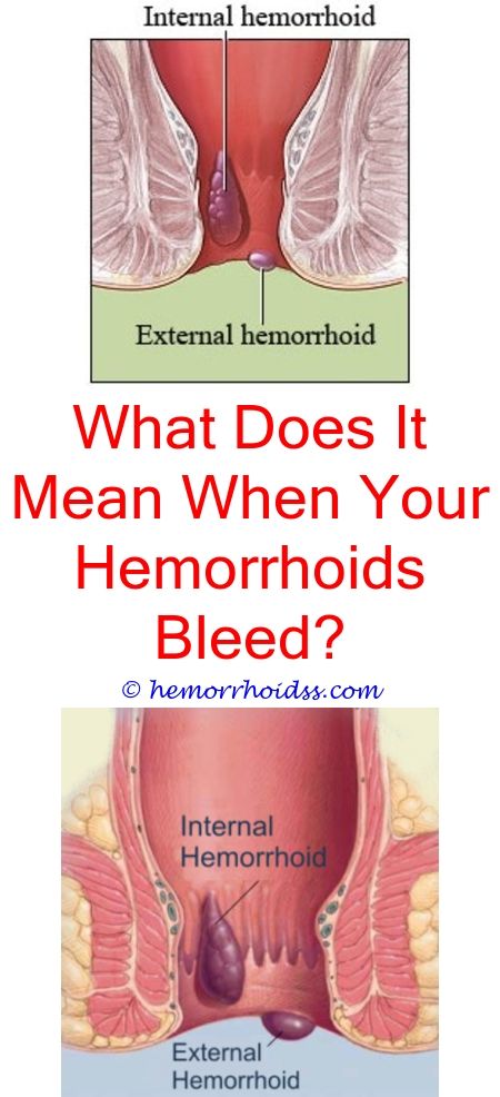 how do you know if you have hemorrhoids or piles where to buy