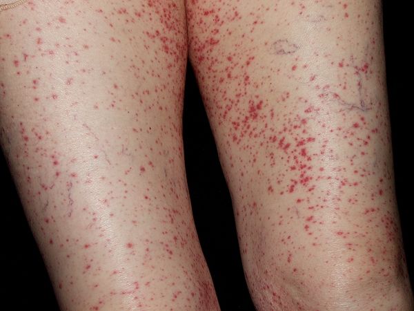 Ejercicio piernas gluteos de vasculitis y