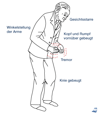 Parkinson Verlauf Wikipedia Parkinson Verlauf Wikipedia