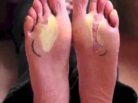 que es ampollas en los pies