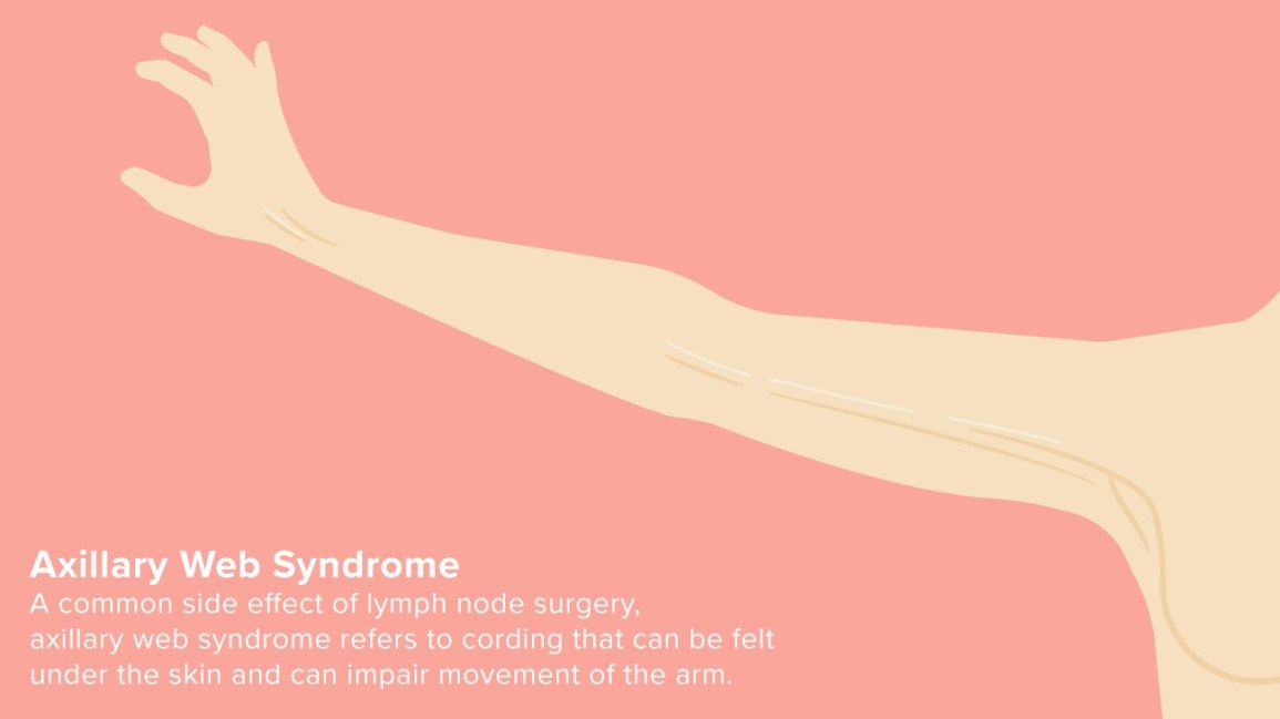 Axillary Web Syndrome (Cording)