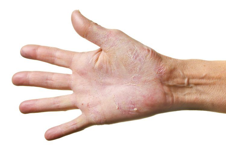 rest psoriasis kezelése