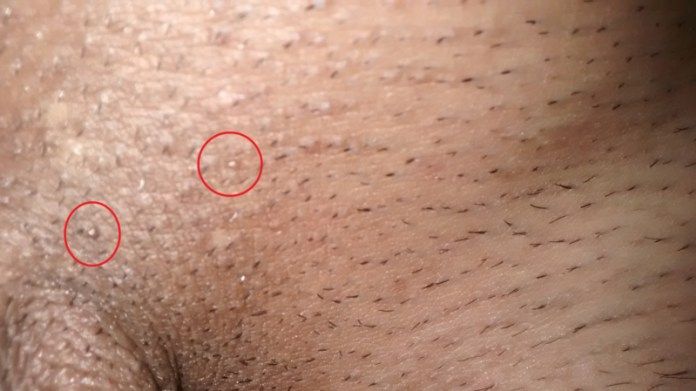 genital warts in penis Sex in royston