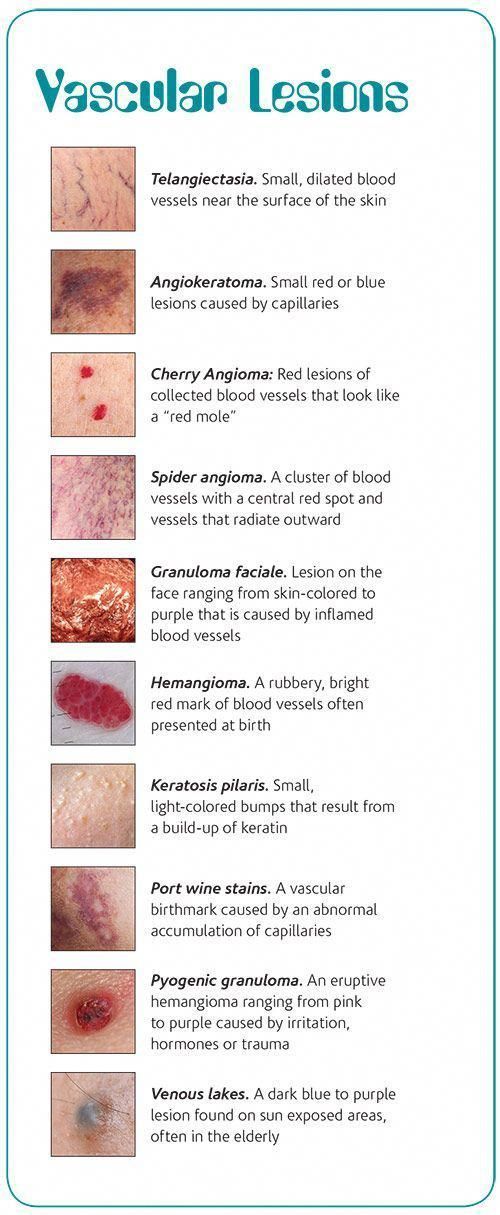 Skincareroutine Estheticians Vascular Lesions Guide An Toan