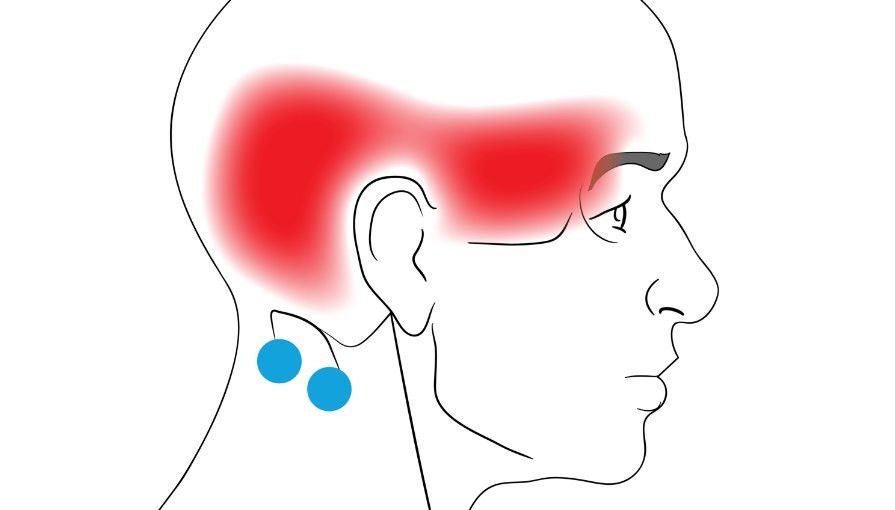 Trigger point therapy what are the different types of trigger point 