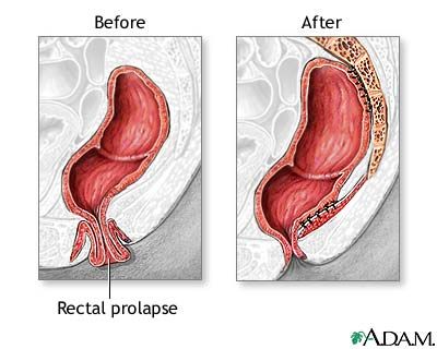 Pin On Pelvic Congestion Syndrome