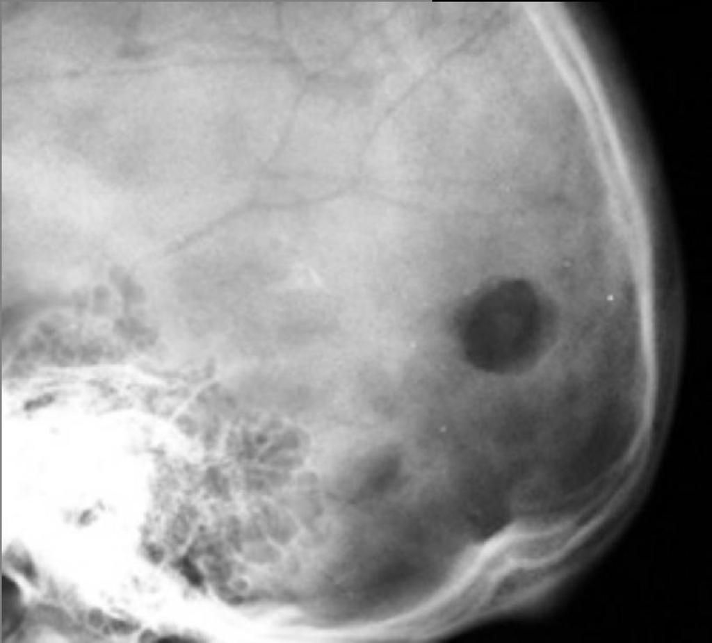 eosinophilic granuloma radiology case radiopaedia org eosinophilic granuloma