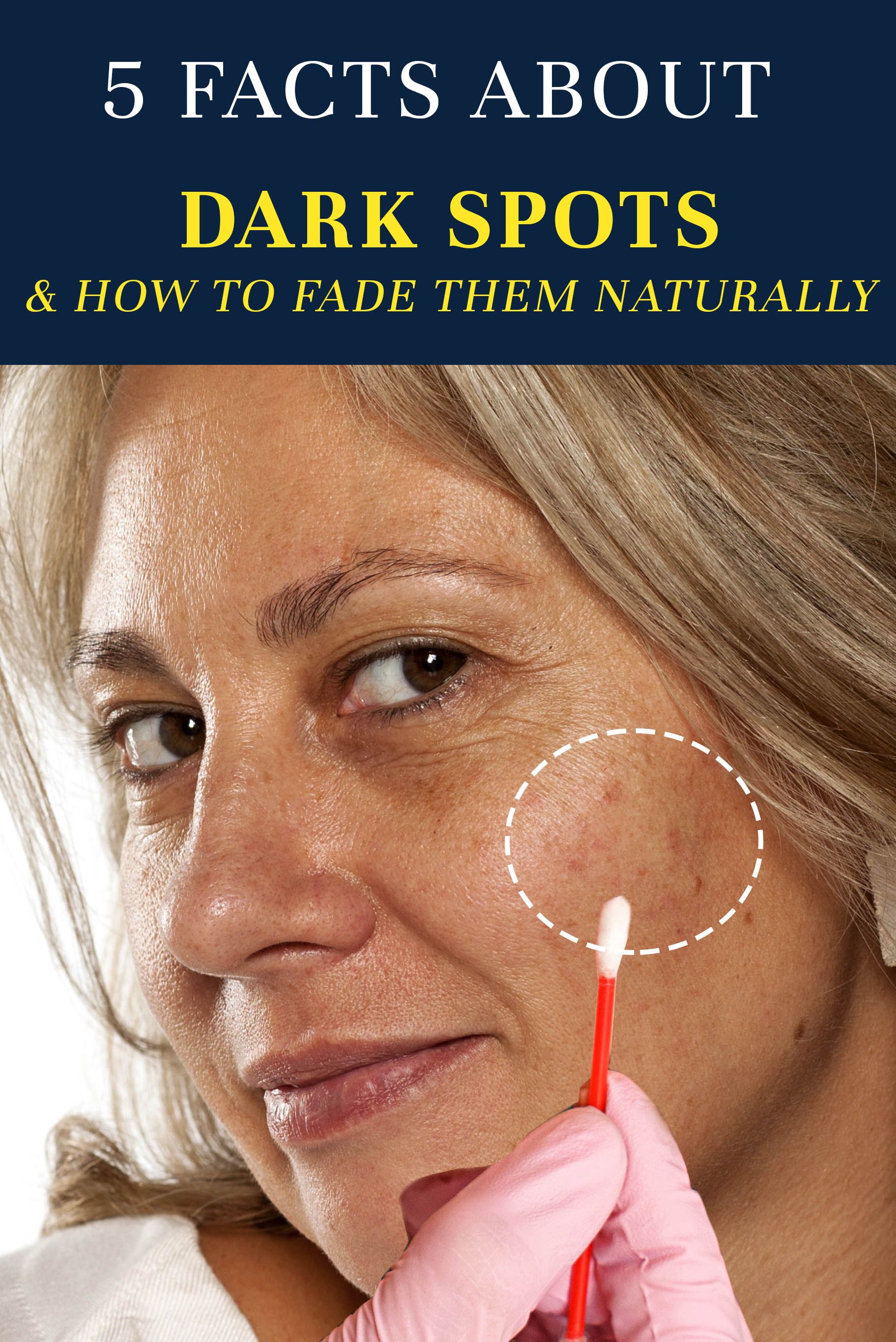 How To Fade Dark Spots Naturally