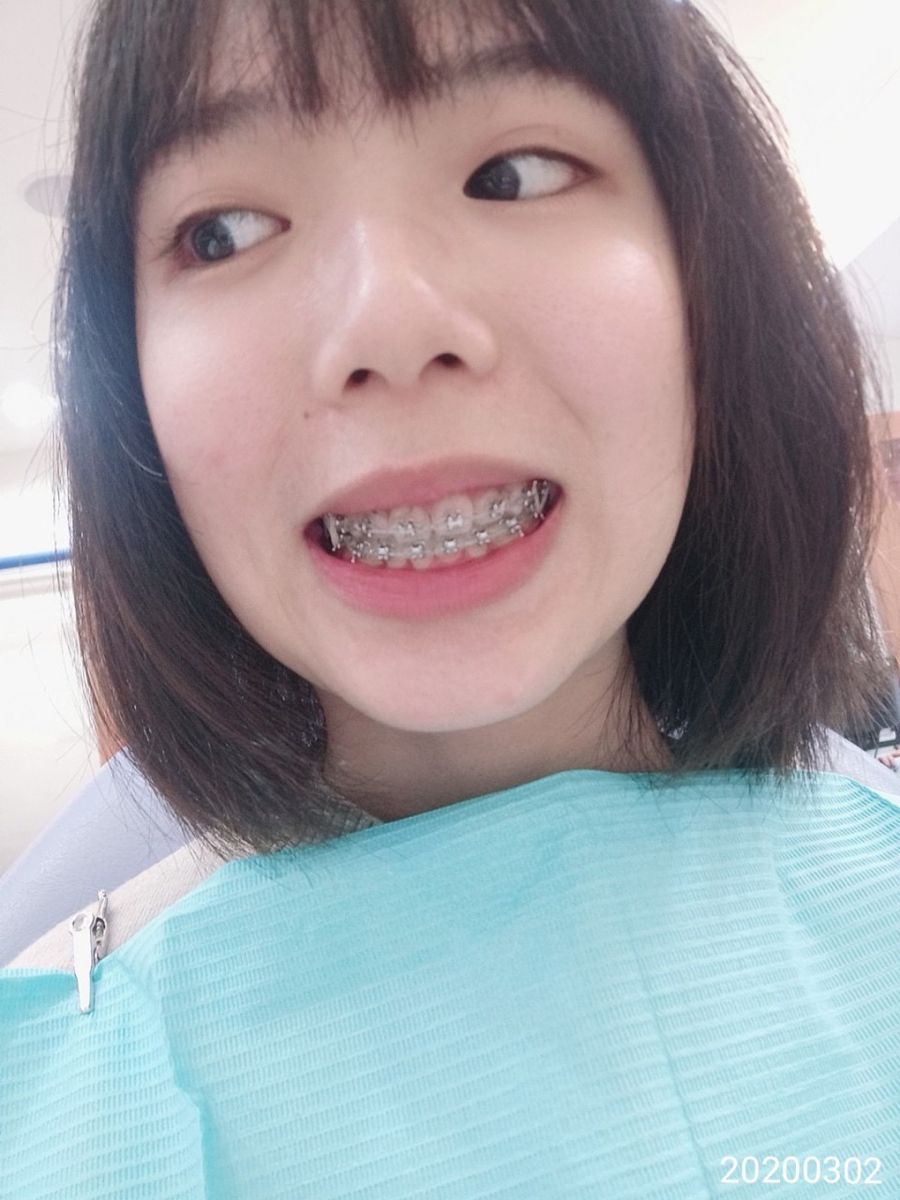 Pin By Shrood Burgos On Braces In 2021 Braces Tips Braces Girls Metal Braces 