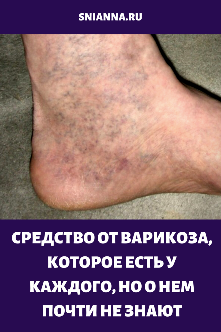 Telangiectaziile Terapie Cu Laser Targu Frumos