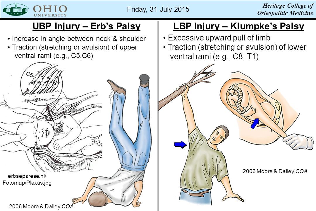 resultado de imagen de erb duchenne y klumpke neurology erb duchenne