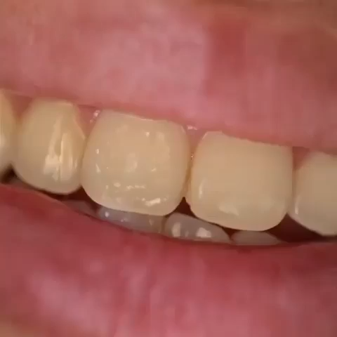 Ter Dentes Brancos Nunca foi Tão Fácil Com Este Pr Ter Dentes Brancos Nunca foi Tão Fácil Com Este Pr
