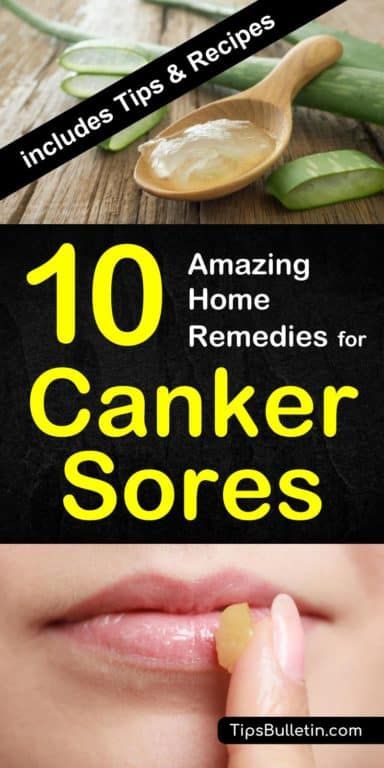 10 Amazing Homemade Solutions for Canker Sores