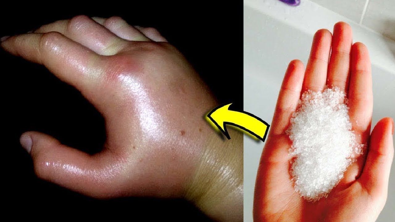 reduce swelling bumble bee sting reduce swelling bumble bee sting