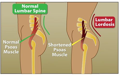 13 Ideas De Columna Lumbar Columna Lumbar Columna Vertebral Lumbar Lumbares