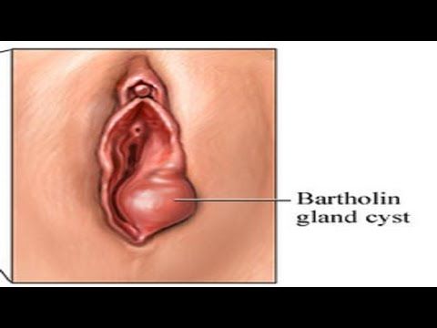 vaginal cyst cause Jetta car gay man