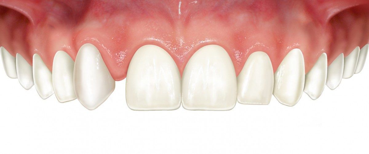 agenesia de todos los dentistas agenesia de todos los dentistas