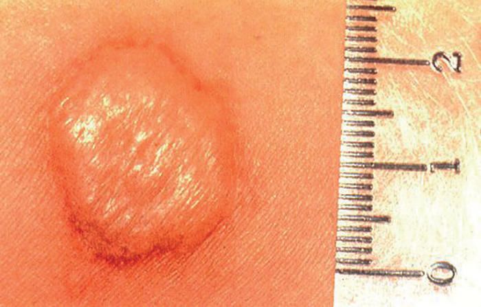 Como se realiza la prueba de tuberculina