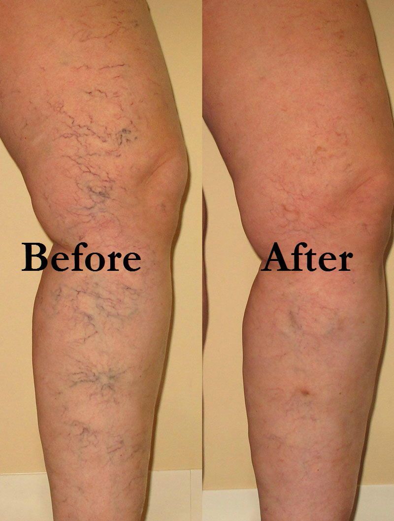 How to remove spider veins with a laser 91 How to remove spider veins with a laser 89
