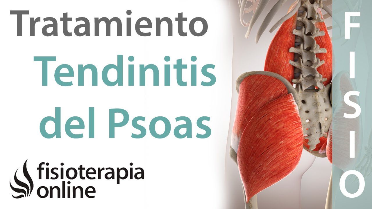 Psoitis O Tendinitis Del Psoas Tratamiento Con Ejercicios Auto Masajes Estiramientos Tendinitis Ejercicios De Estiramiento