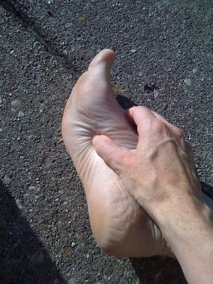 bunions on thumbs Bunions on thumbs