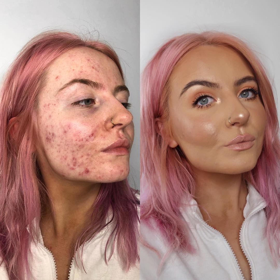 This foundation is going viral after cystic acne sufferer shares her