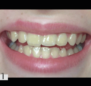 Stylo de blanchiment des dents parfait #bestteethwhitening
