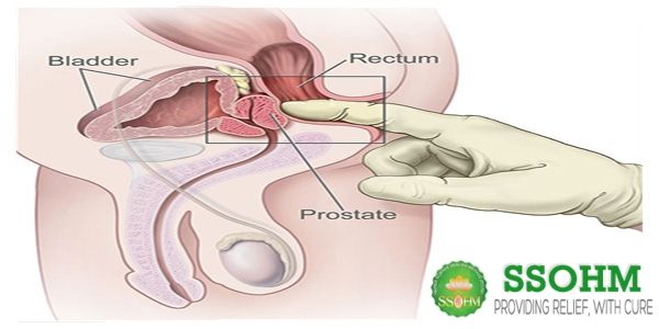Discussion sex after prostate cancer seed implant have hit Sex after prostate cancer seed implant