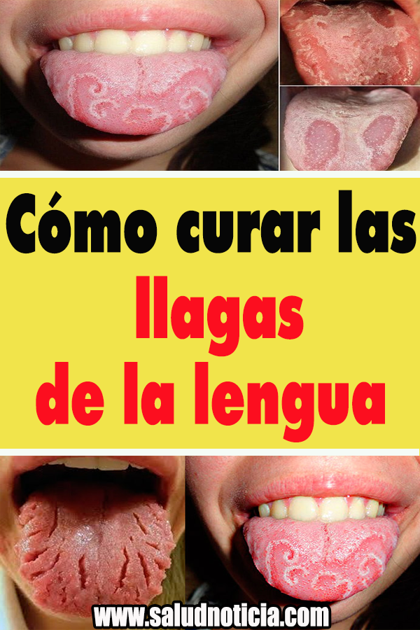 remedio realistic pregnancy aliviar las llagas de solfa syllable lengua