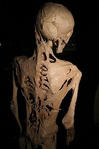 fibrodisplasia osificante progresiva
