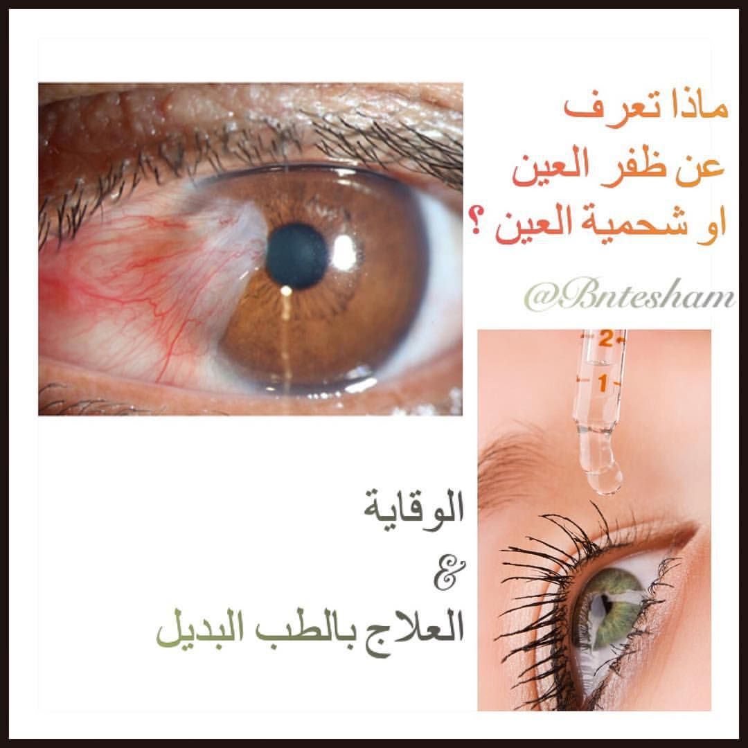 Pin On أمراض العيون
