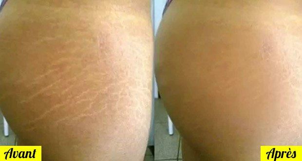 10 Remèdes Naturels Contre Les Vergetures Vergetures Enlever Les Vergetures Vergeture