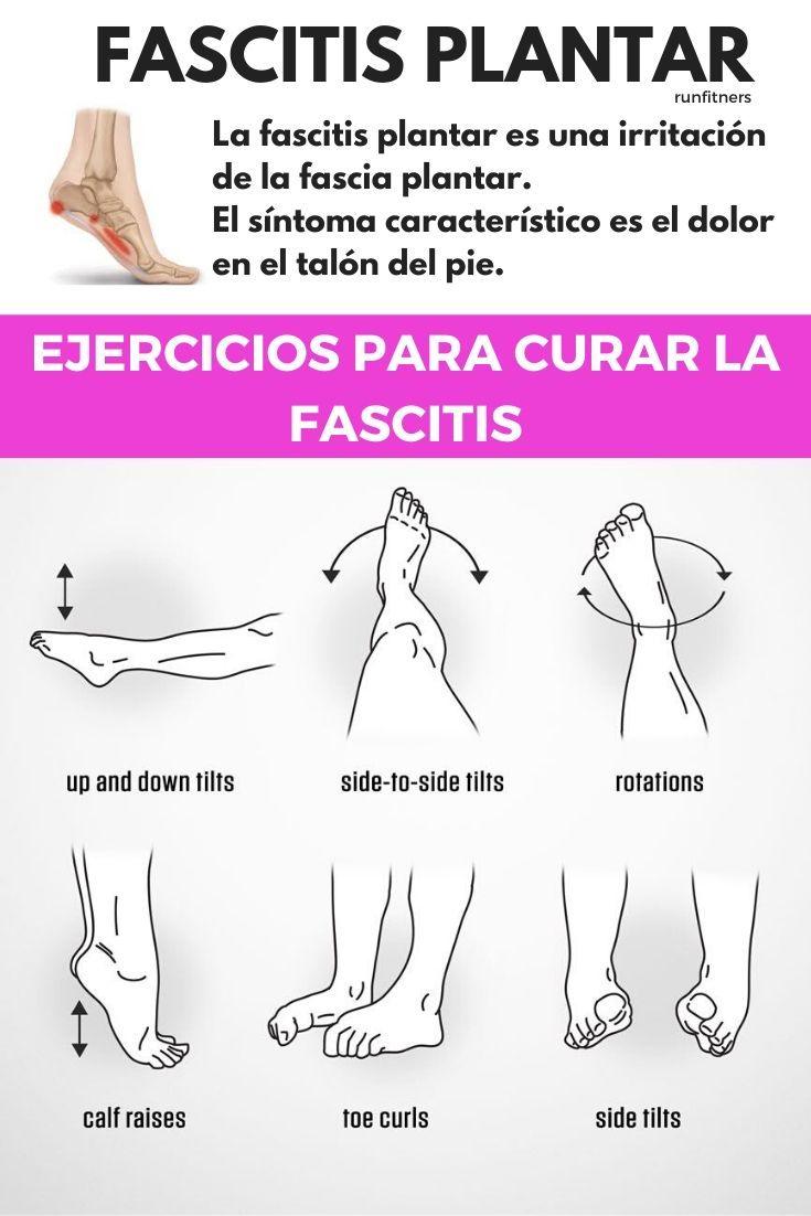 cura natural de la fascitis plantar