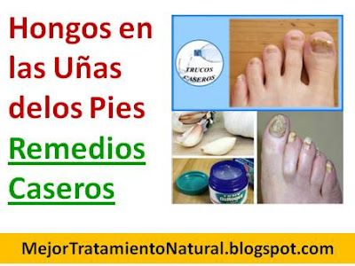 Tratamiento pies unas delos con hongos