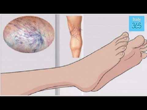 preparate ieftine din varicoza varicoza i tomografie