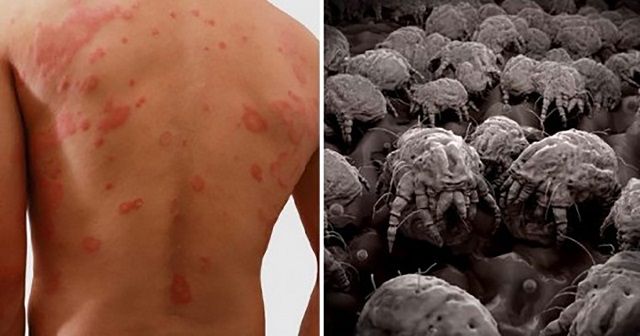 poratka Dust Mite Allergy, Remedies For Tooth Ache, Hard Breathing, Flea Prevention, Natural Health Care, Runny Nose, Natural Solutions, Health Tips, Cleaning
