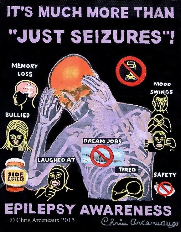 Epilepsy Awareness painting #12 MORE THAN "JUST SEIZURES" Have you ever heard someone say the Epilepsy is “just seizures”? People who are living with Epilepsy face a lot more than just seizures! Epilepsy also causes memory problems and mood swings that can include depression, anxiety, and anger or rage. Anti-seizure medicines can make them worse and have other dangerous side effects. Epilepsy Awareness Quotes, Epilepsy Facts, Temporal Lobe Epilepsy, Epilepsy Seizure, Epilepsy Symptoms, Migraine Relief, Migraine Headaches, Seizures Quotes, Seizure Disorder