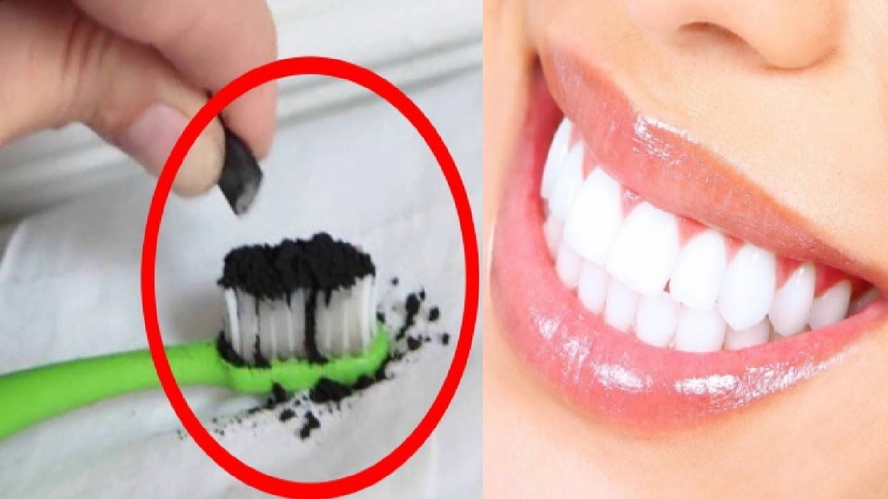como quitar el sarro negro delos dientes en casa