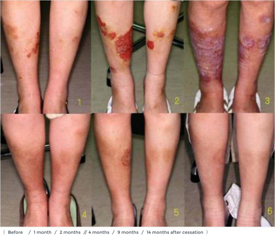 Natural Remedies For Dermatitis On Legs Natural Remedies For Dermatitis On Legs